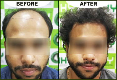 HHY Hair Transplant Clinic in Andheri west  Mumbai Bhubaneswar  Guwahati